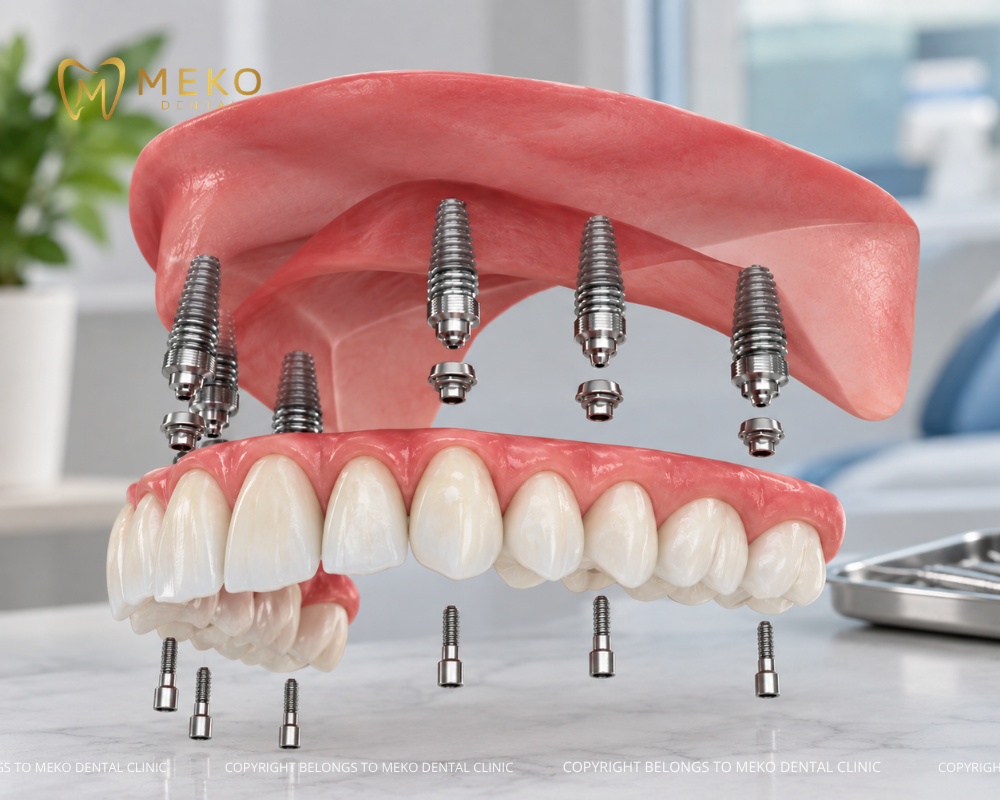 Trụ implant Mỹ