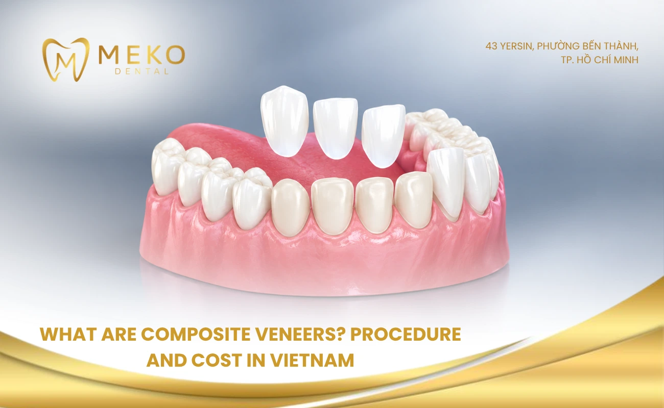 What are composite veneers? Procedure and cost in Vietnam