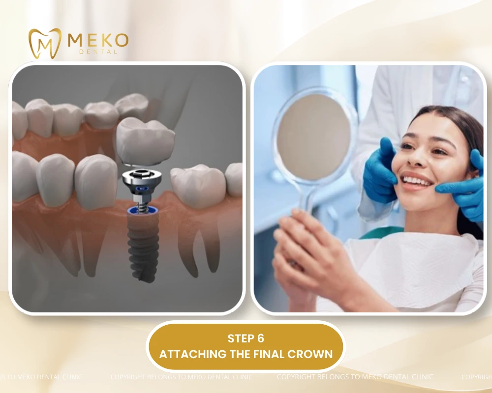 what is the process for a dental implant