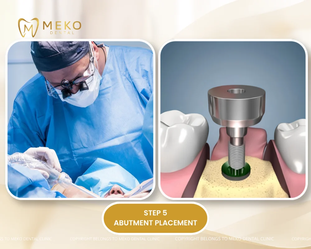 dental implants procedure step by step