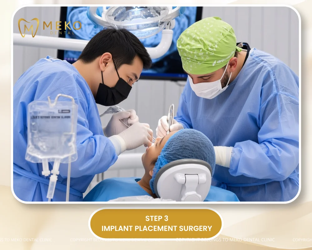 dental implant process step by step