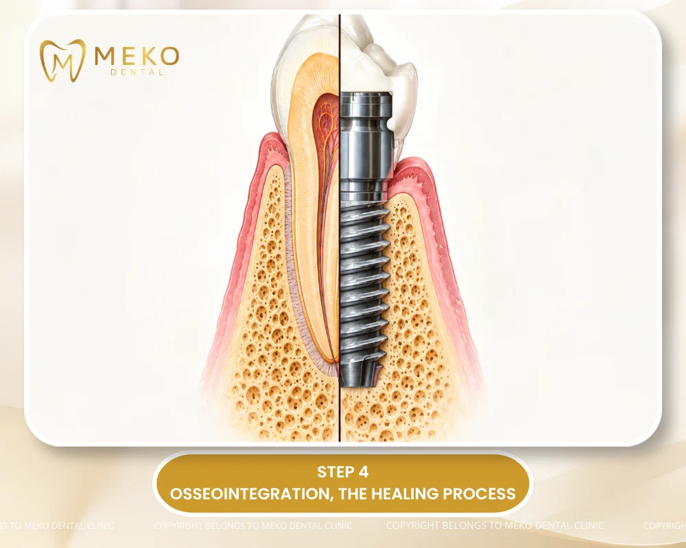 dental implants process