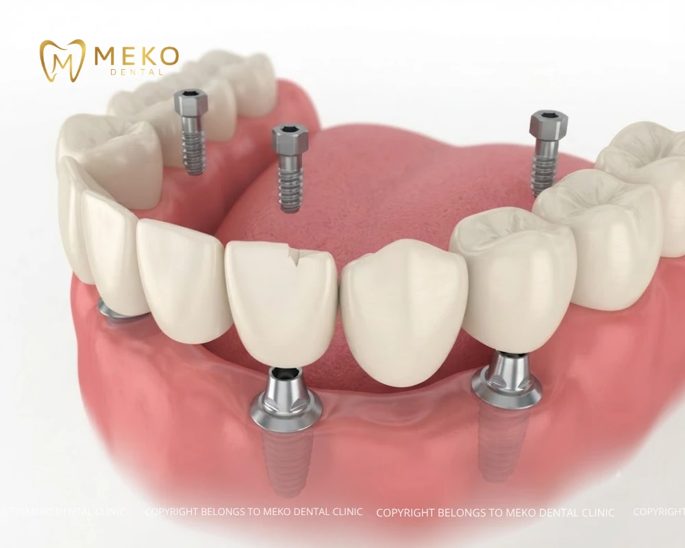 Dental implants for missing teeth