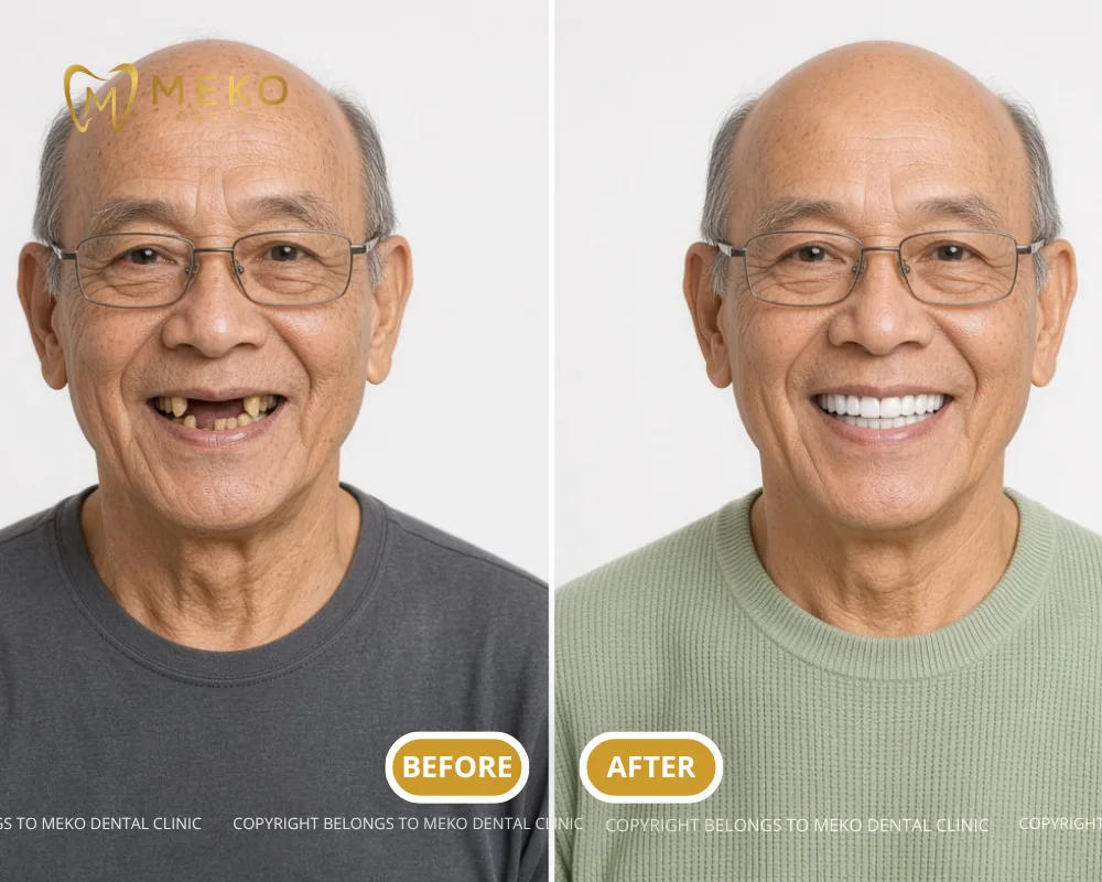 dental implants for tooth loss