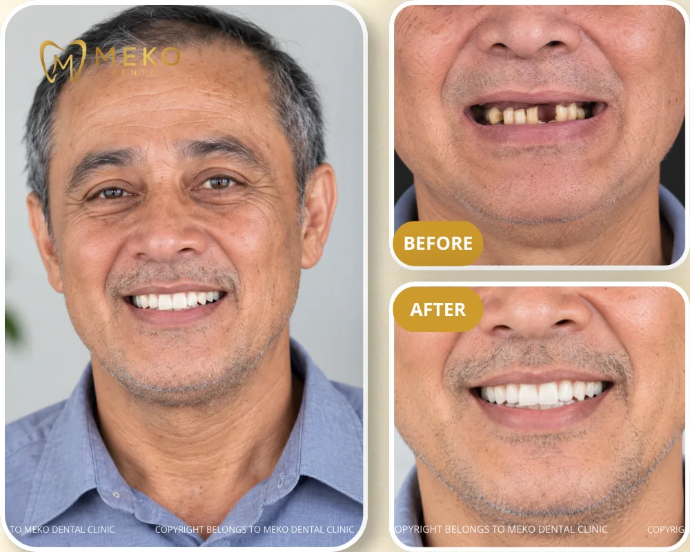 dental implants for missing tooth