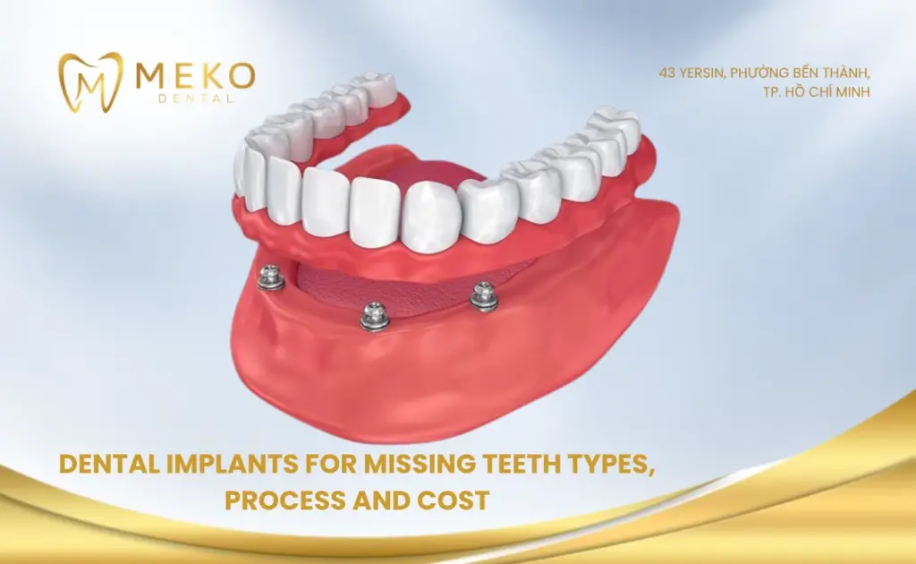 Dental implants for missing teeth types