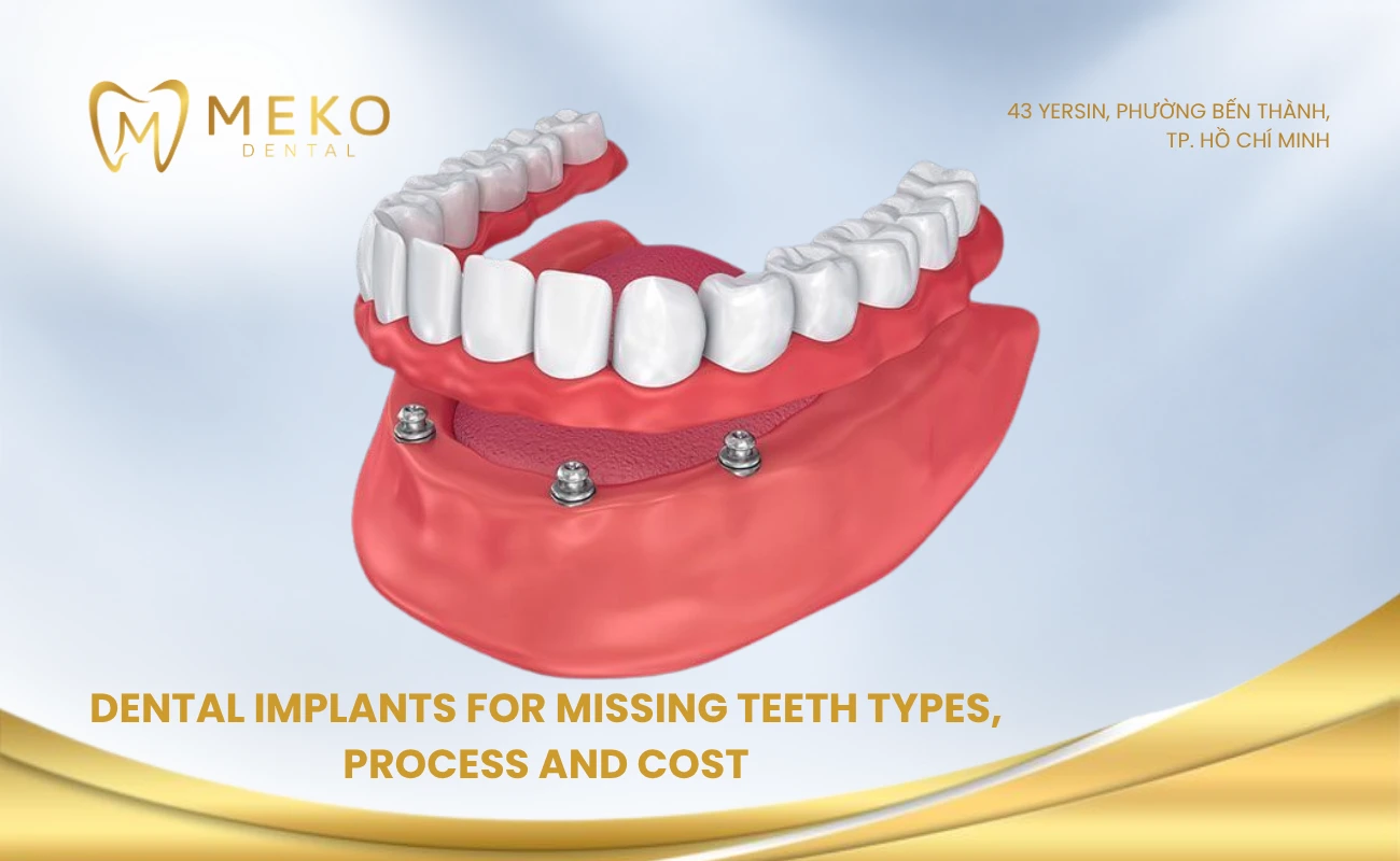 Dental implants for missing teeth types, process and cost 2026