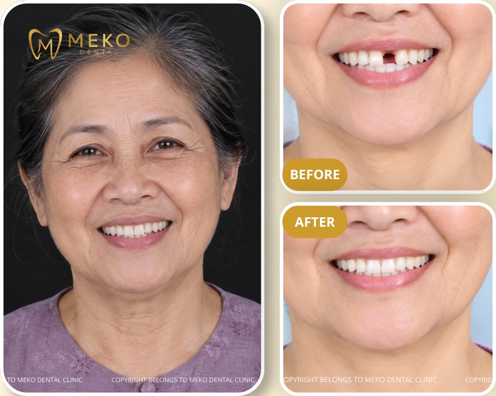 dental implants missing teeth