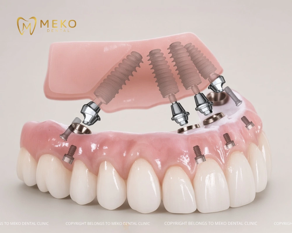 dental implants seniors