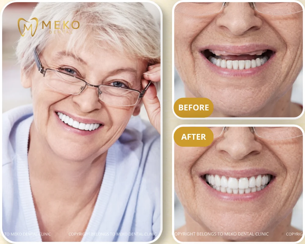 Dental implants for seniors