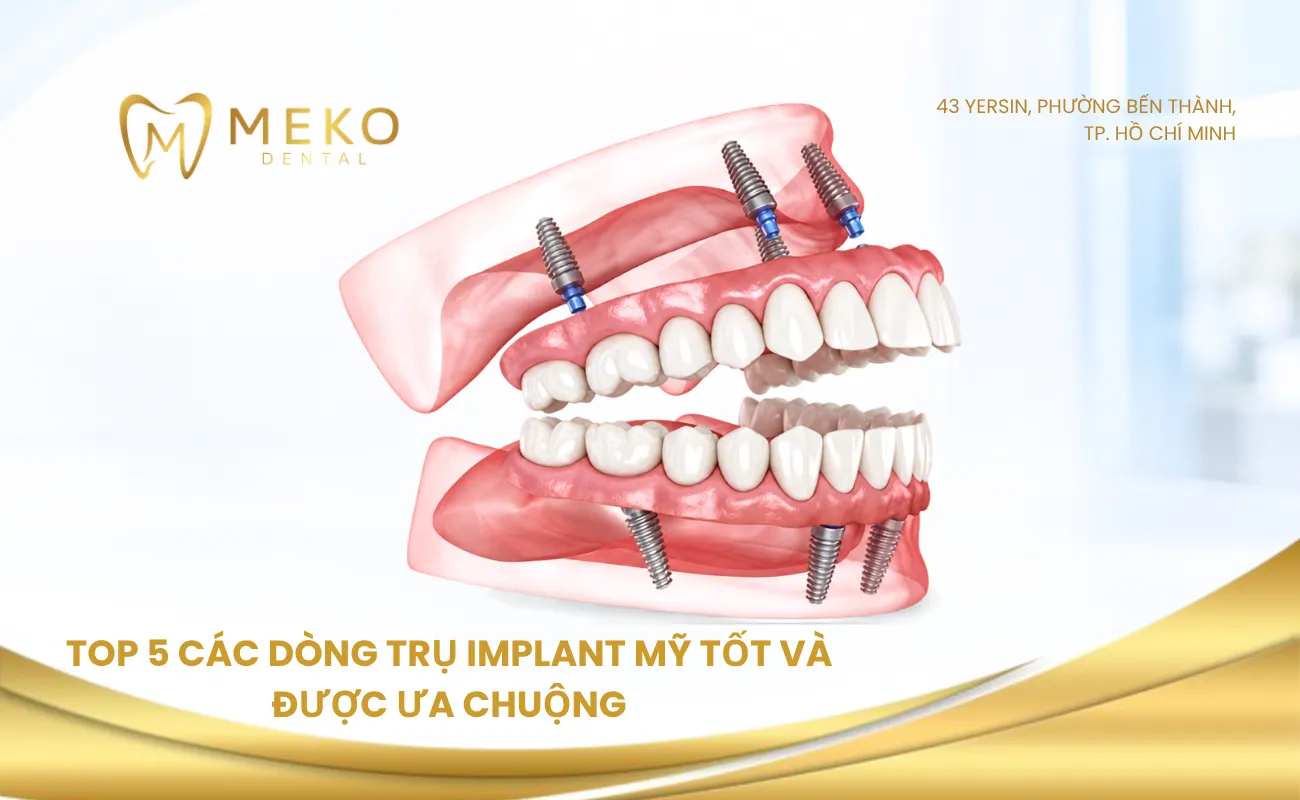 Top 5 các dòng trụ implant Mỹ tốt và được ưa chuộng năm 2026