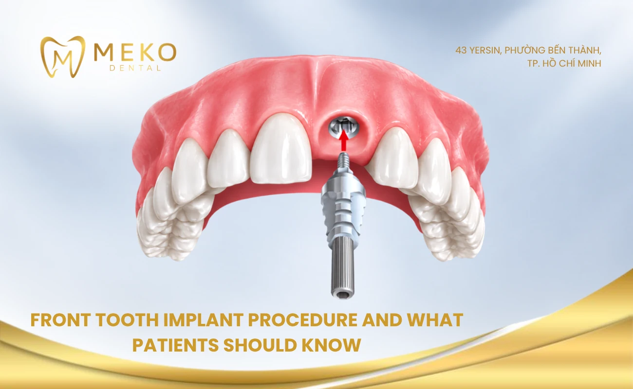 Front tooth implant procedure and what patients should know