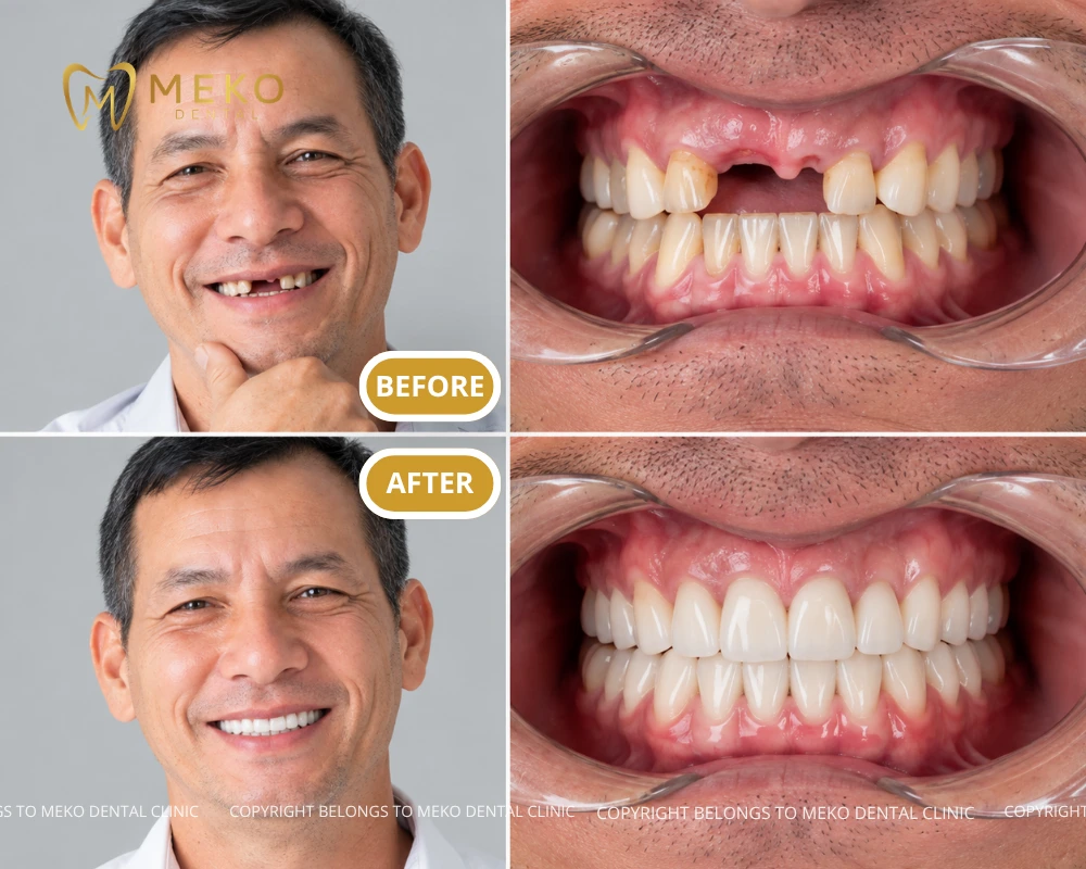 front tooth implants