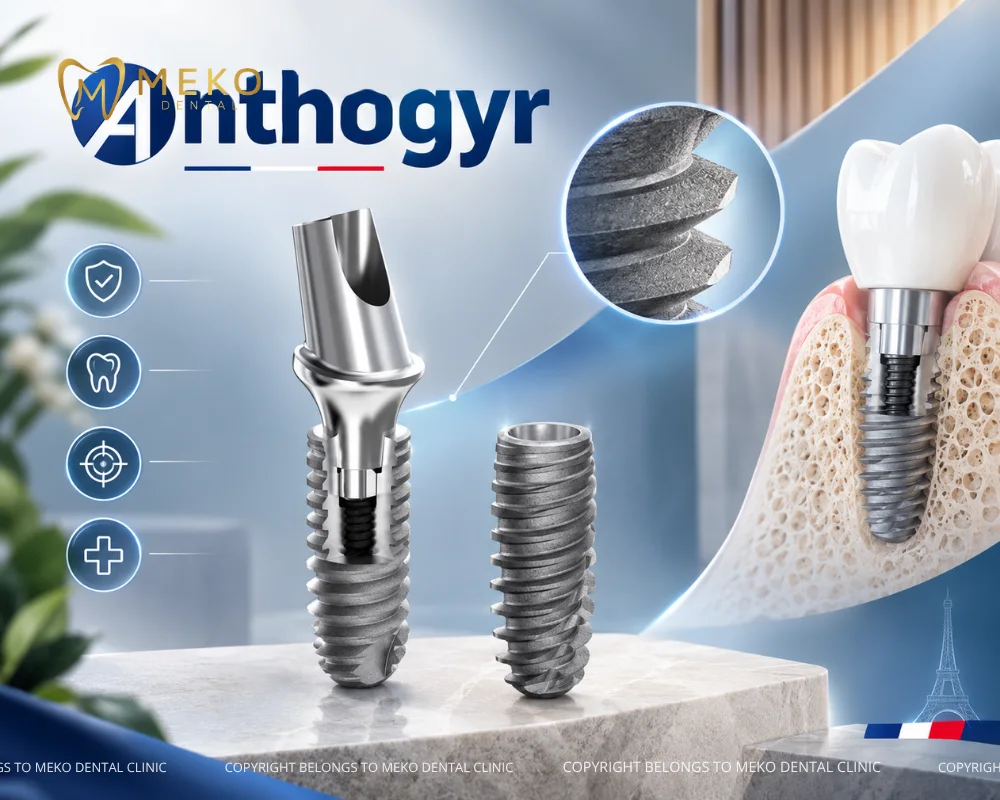 trụ răng implant pháp