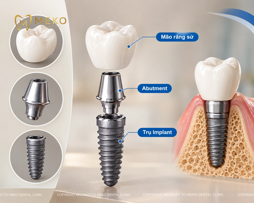 cấu tạo implant pháp