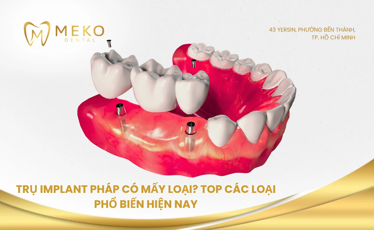Trụ implant Pháp có mấy loại? Top các loại phổ biến hiện nay