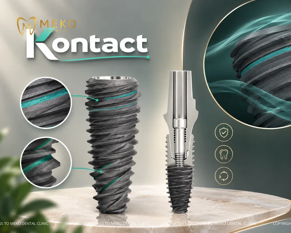 trụ implant của pháp