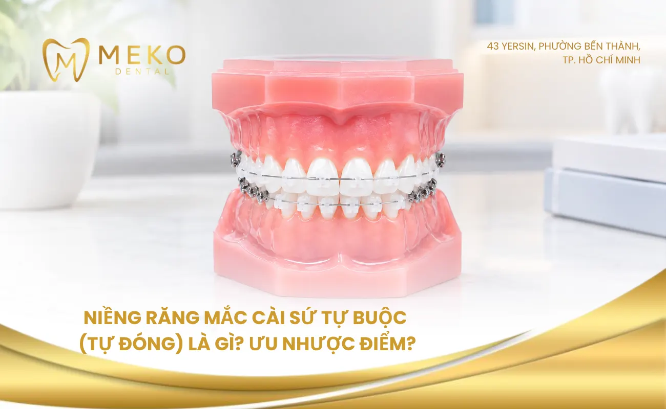 Niềng răng mắc cài sứ tự buộc (tự đóng) là gì? Ưu nhược điểm?