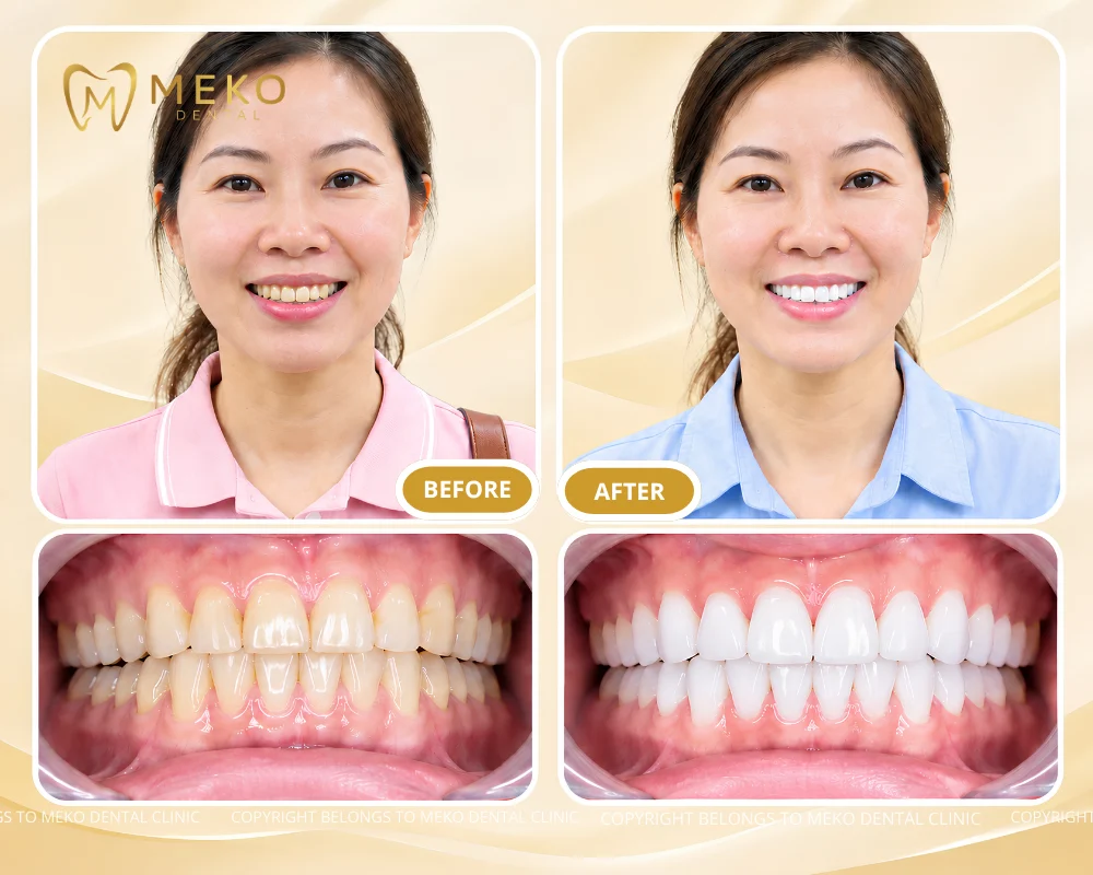 laser teeth whitening pros and cons