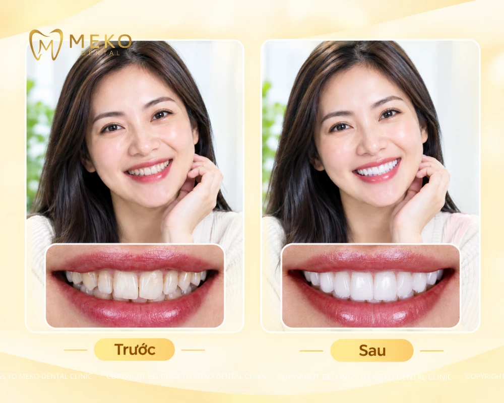 bọc răng sứ venus