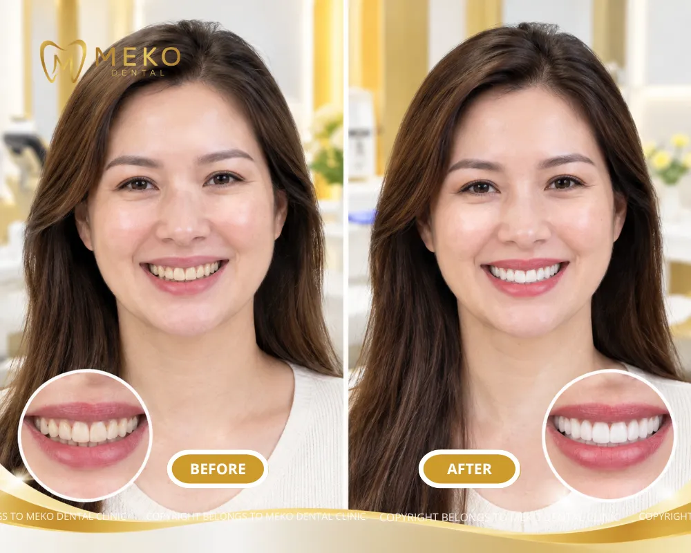 teeth whitening benefits