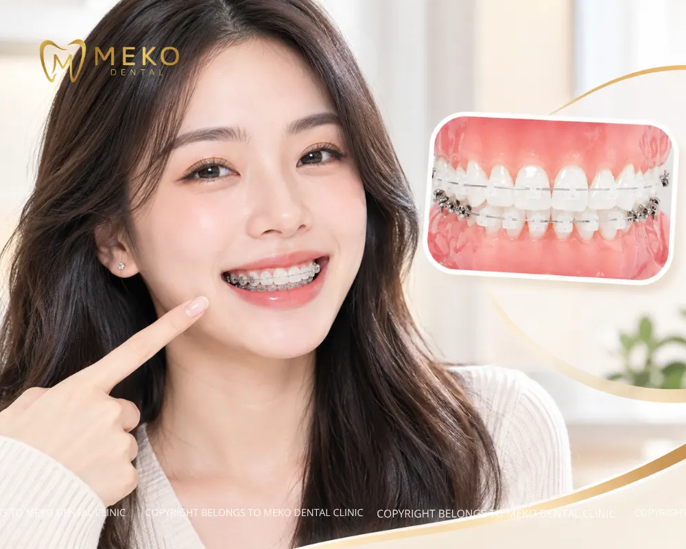 niềng răng mắc cài sứ tự buộc
