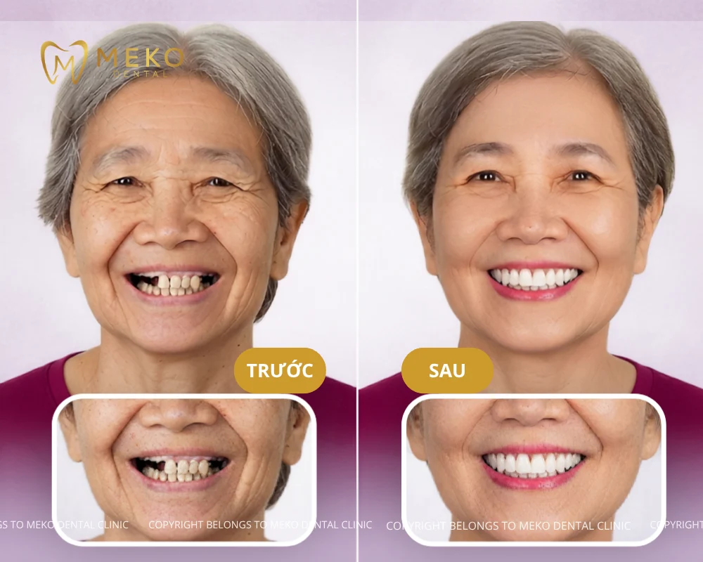 trụ implant đức có tốt không