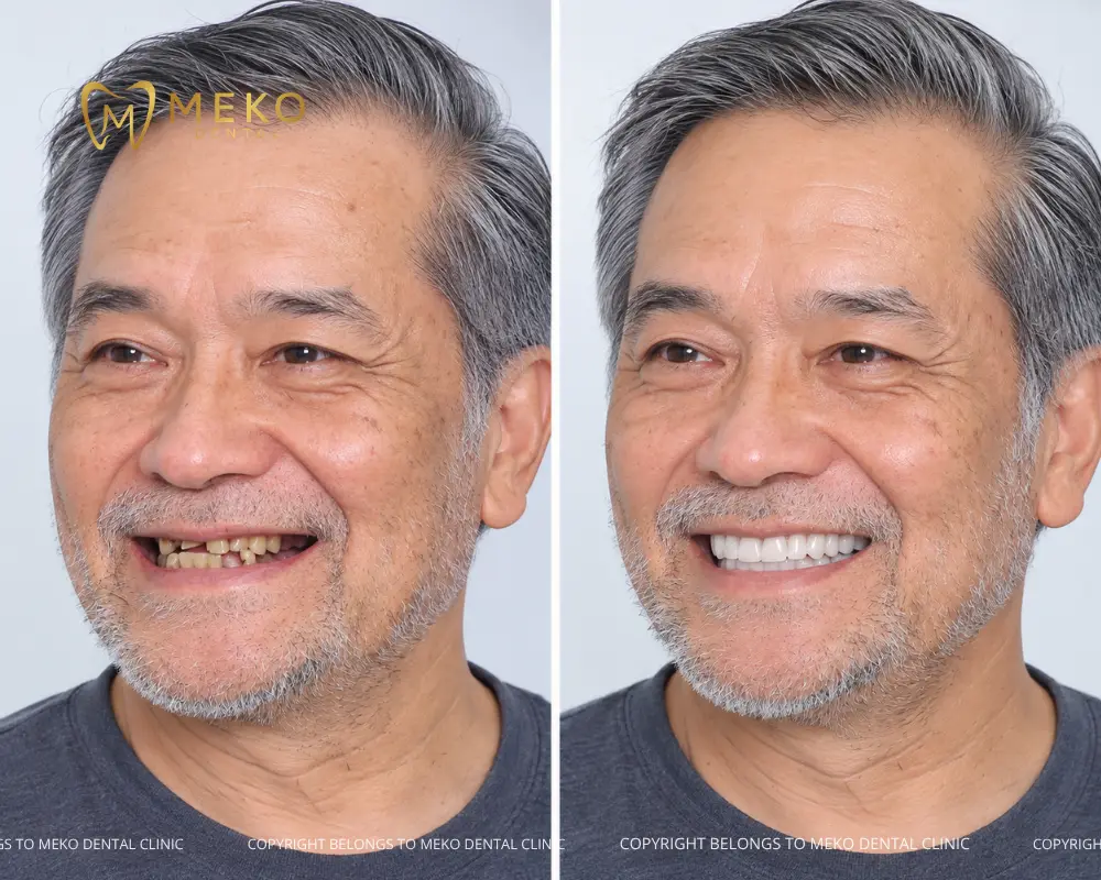 trồng răng implant thụy sĩ