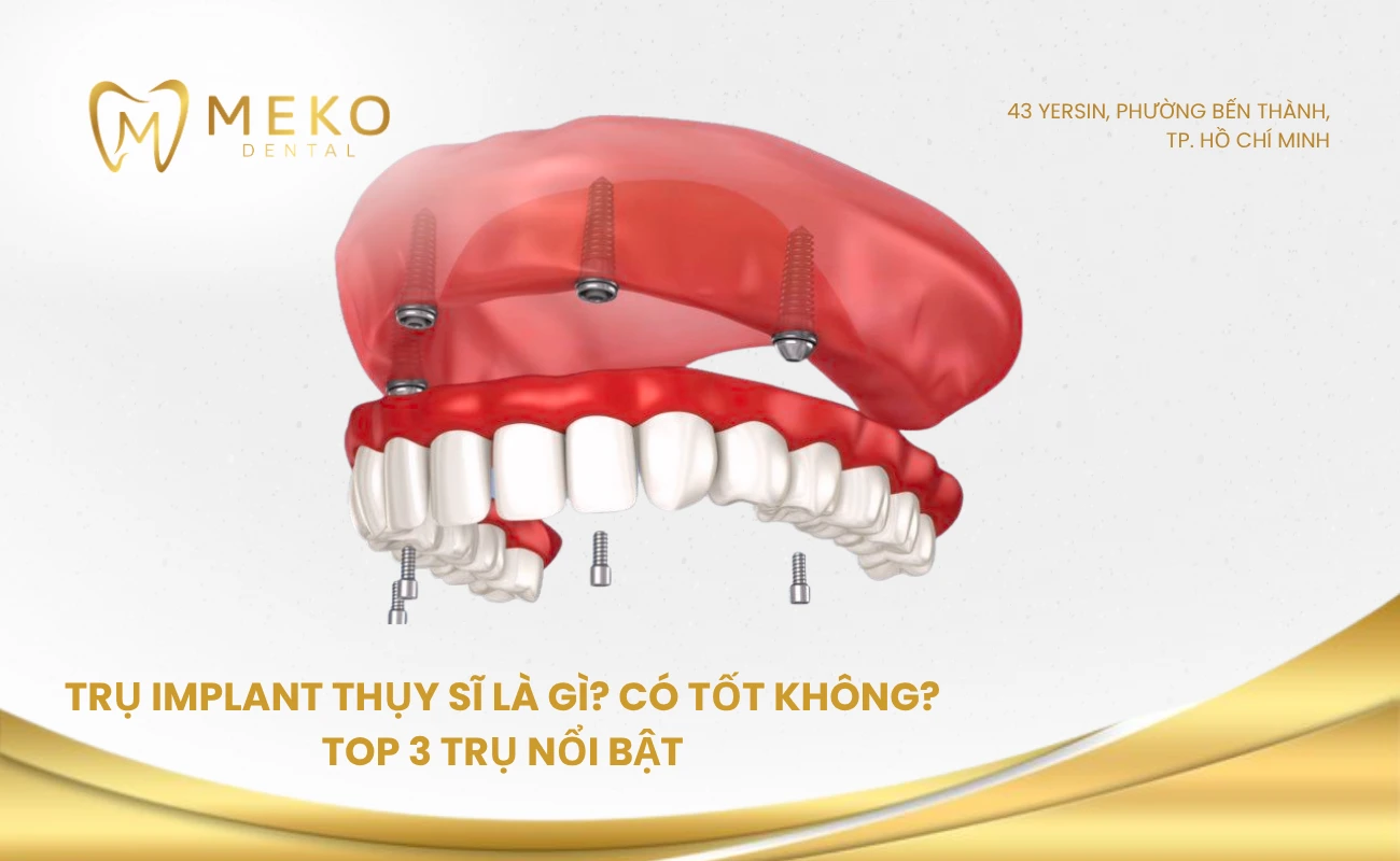 Trụ implant Thụy Sĩ là gì? Có tốt không? Top 3 trụ nổi bật