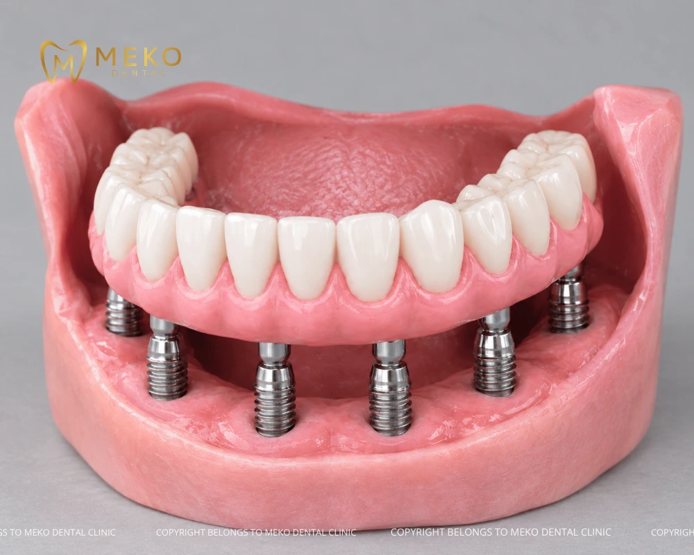 trụ implant thụy sĩ