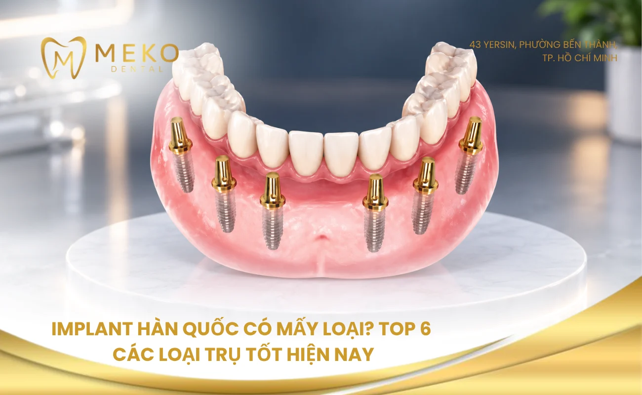 Trụ implant Hàn Quốc có mấy loại? Top 6 các loại trụ tốt hiện nay