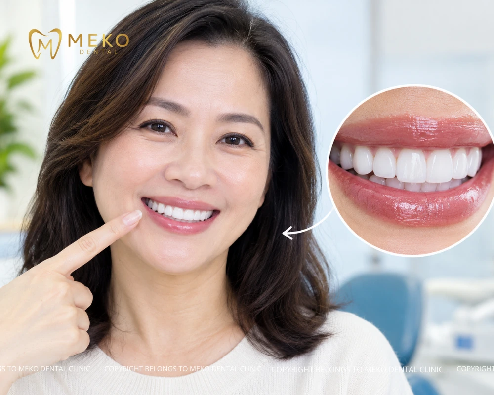 is zirconia veneers permanent