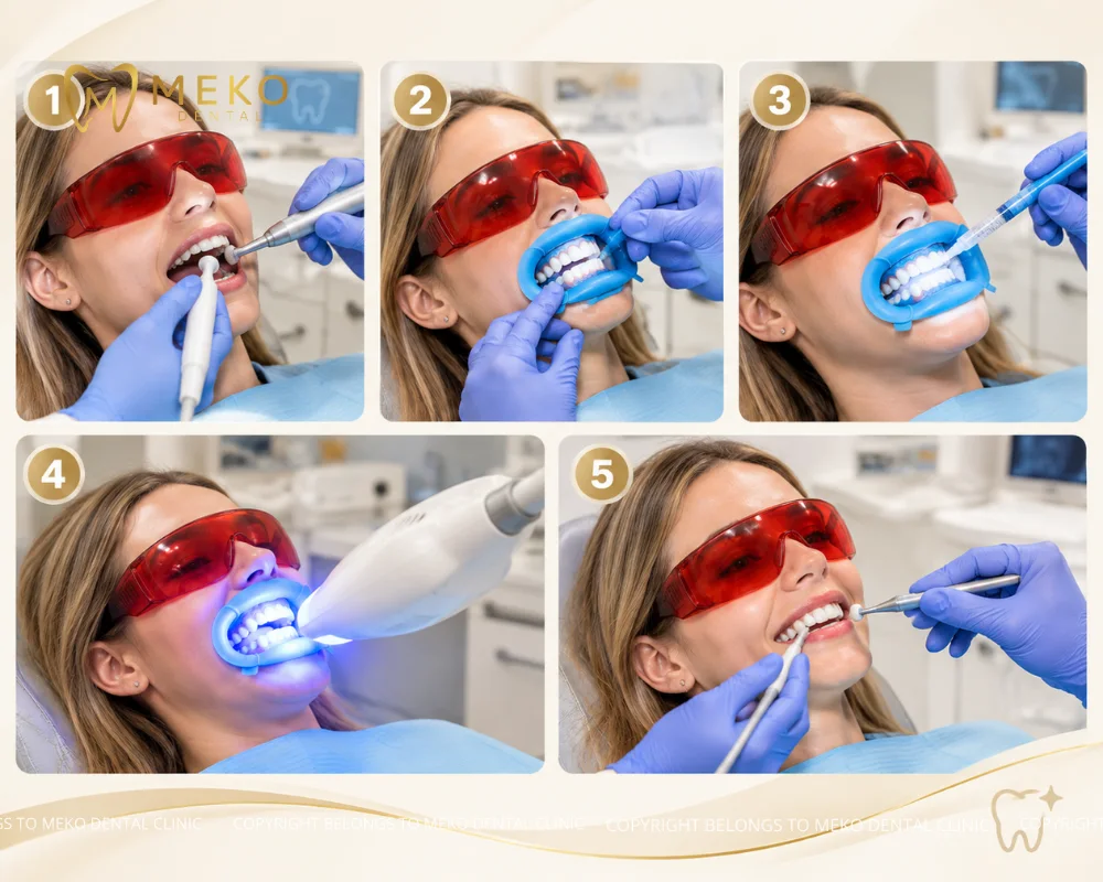zoom whitening process