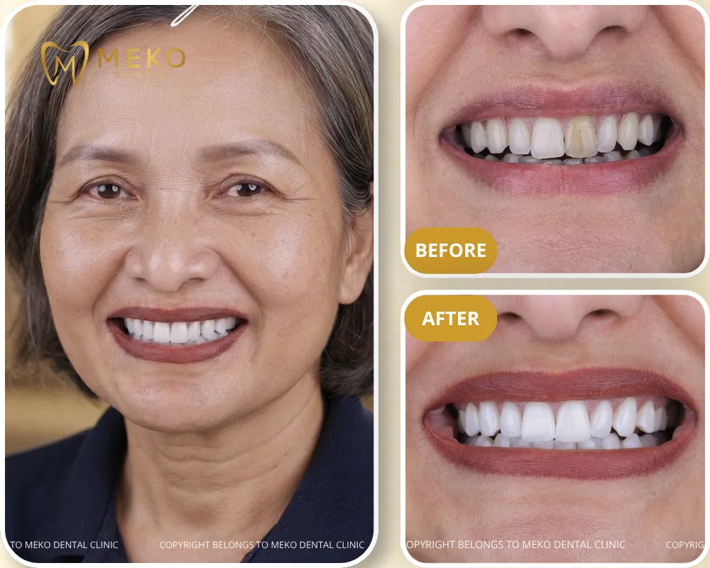 zoom teeth whitening in office results